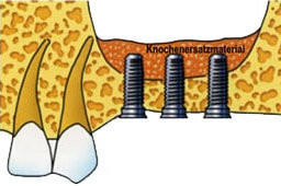 3 Schraubimplantate bekommen mehr Halt Darstellung 3 eingesetzter Schraubimplantate
